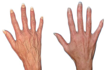 Effect of Neoveris in the treatment of varicose veins in the hands