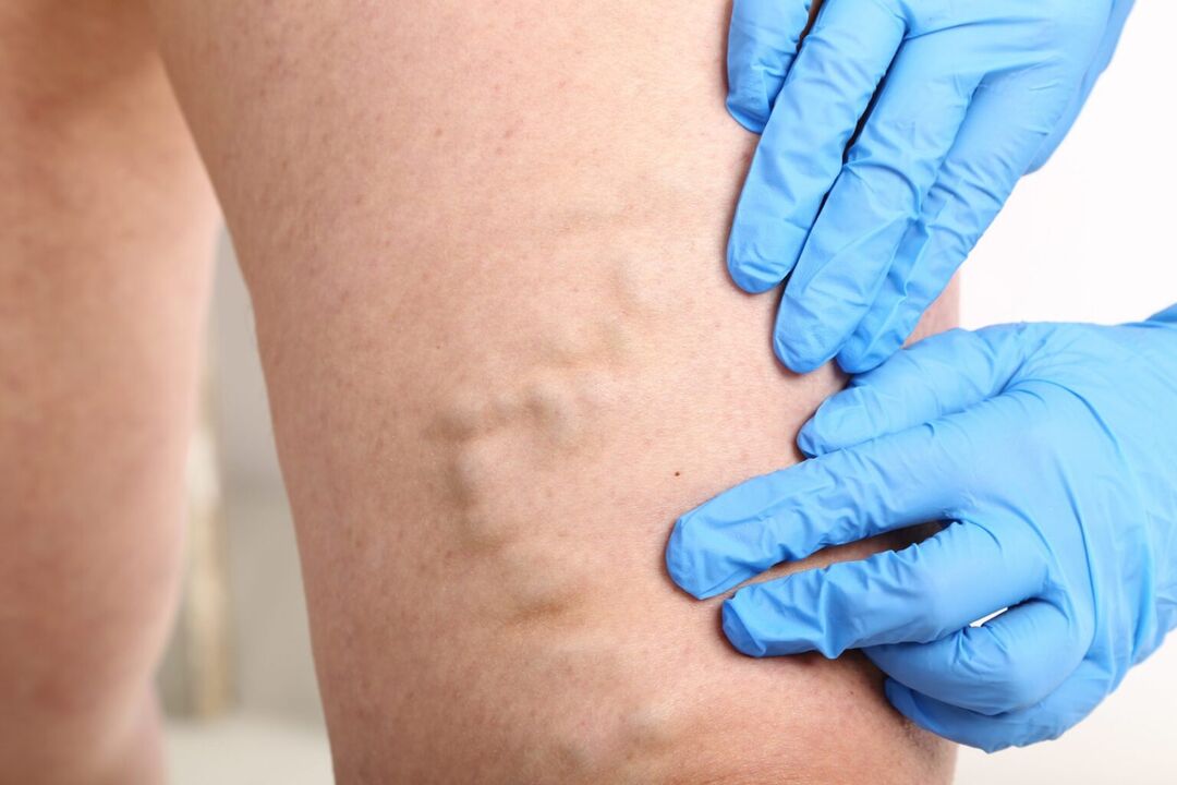 varicose vein symptoms