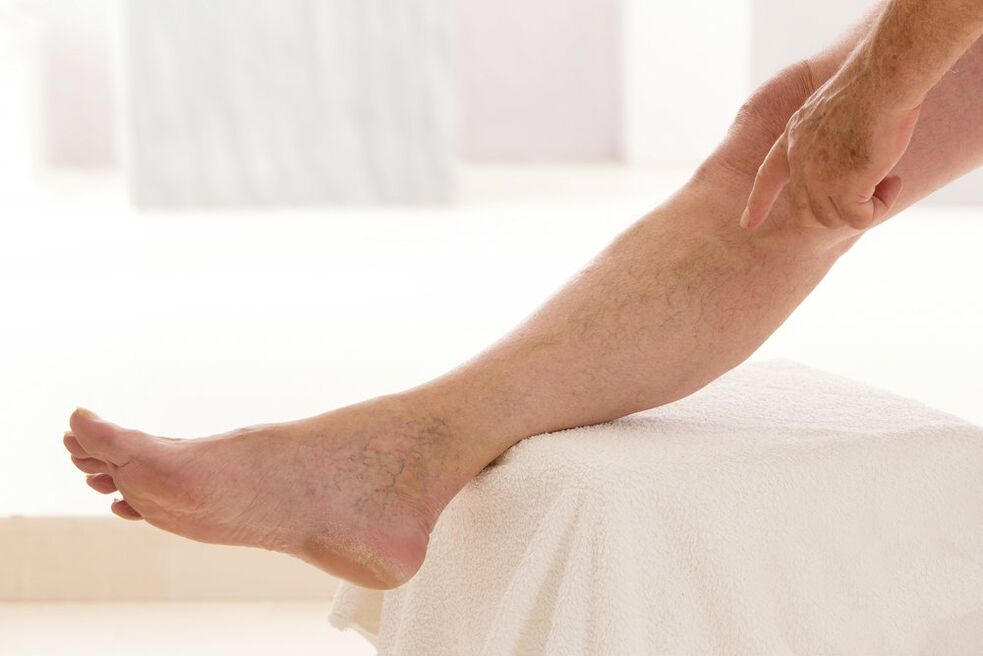 Varicose veins in the legs