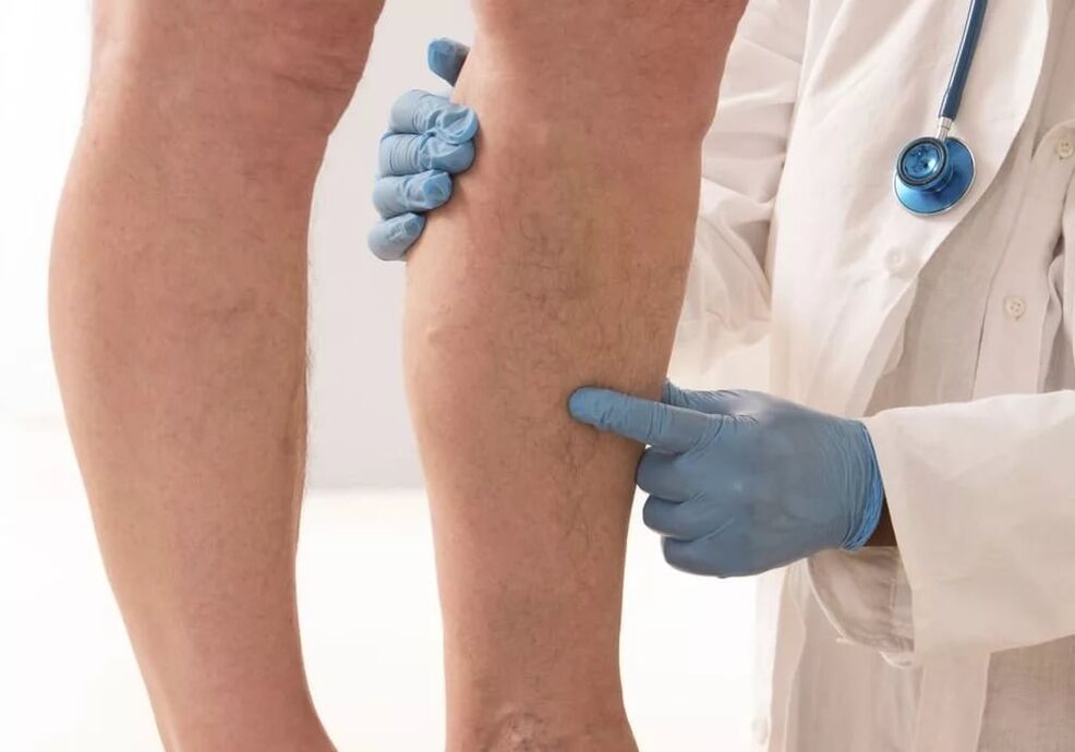 Varicose veins