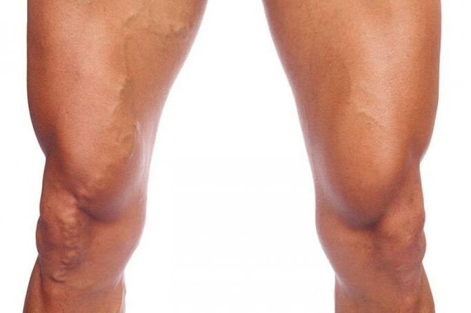 varicose veins
